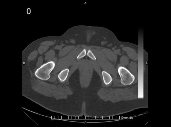 CT Scan Video Slide Animations. Abdominal cross section slices of a male subject showing the bladder, spine, prostate, liver, hip,spine, intestines and more.All ID Info has been cloned out and removed