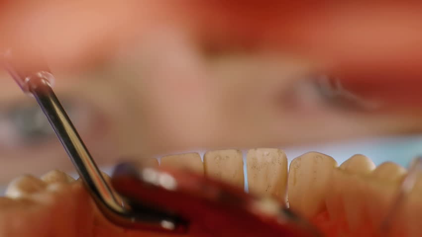Cleaning Teeth Inside Mouth (HD). Dentist cleaning teeth Inside mouth with plaque remover tool and mirror. Shot with custom made mouth prosthesis. 