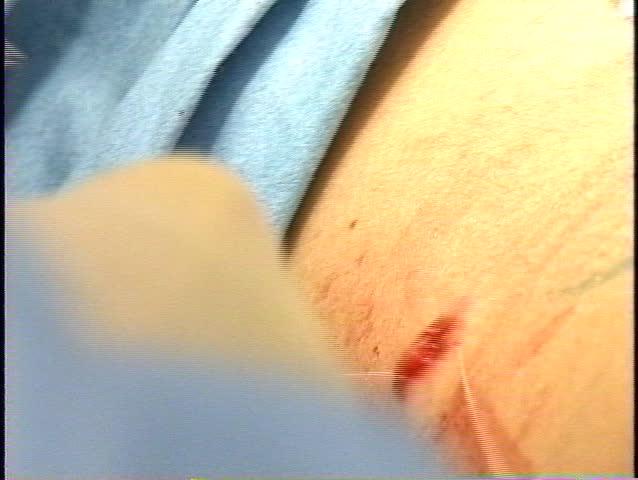 Stitching the wound