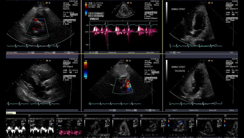 Echocardiogram shows 6 views of valsalva tests on beating heart