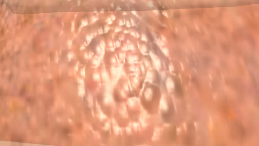Development of emphysemic tissue on the lungs due to the damage caused by chronic smoking