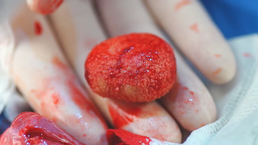 Veterinarian removing extremely large Bladder stone in a dog, calcium oxalate stone due to excessive calcium in diet