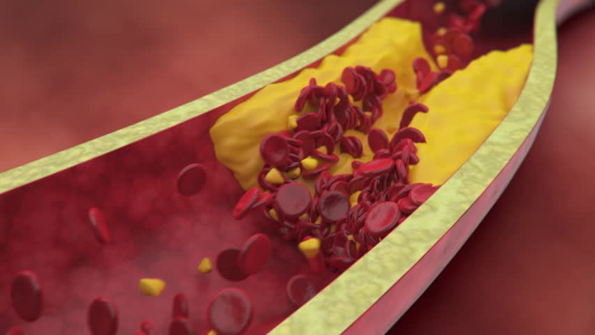 Atherosclerosis: Cholesterol Plaque Forms In Artery, Ruptures, Blood