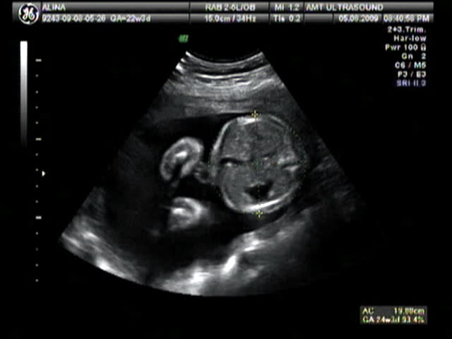 Baby ultrasound time lapse