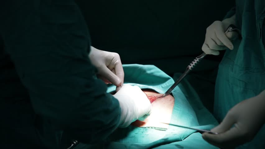 Header of colectomy
