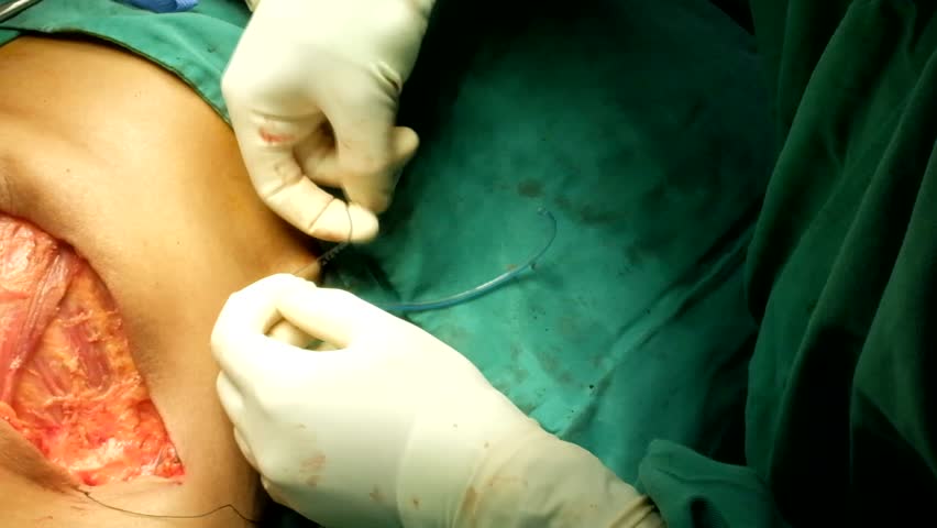 Header of mastectomy
