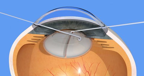 Human Eye Cataract Surgery Manual Cloudy Stock Footage Video (100% Royalty-free) 1010992103 | Shutterstock Human Eye Cataract Surgery Manual Cloudy Stock Footage Video (100% Royalty-free) 1010992103 | Shutterstock