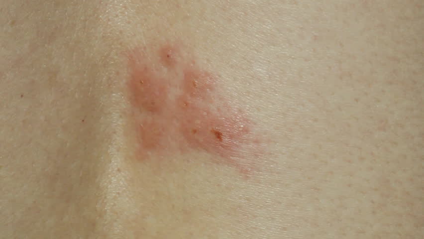 Shingles Rash Stock Footage Video | Shutterstock