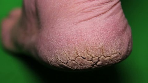 Extremely Dry Cracked Heels Stock Footage Video 100 Royalty Free 15798043 Shutterstock