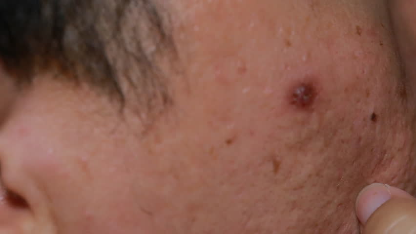 Close Up On Squeezing Pimple Blackheads From Nose Of Teenager With