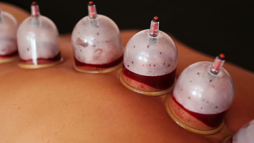 cupping-as-related-to-traditional-chinese-medicine-pictures