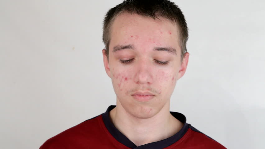 Teenage Boy Squeezing Out Pimples, Face, Mirror, Acne, Zits, Spots ...